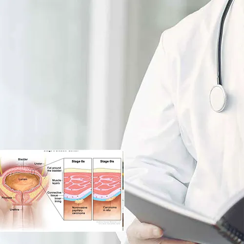 Why Choose   Urology Centers of Alabama 
for Your Penile Implant Surgery?